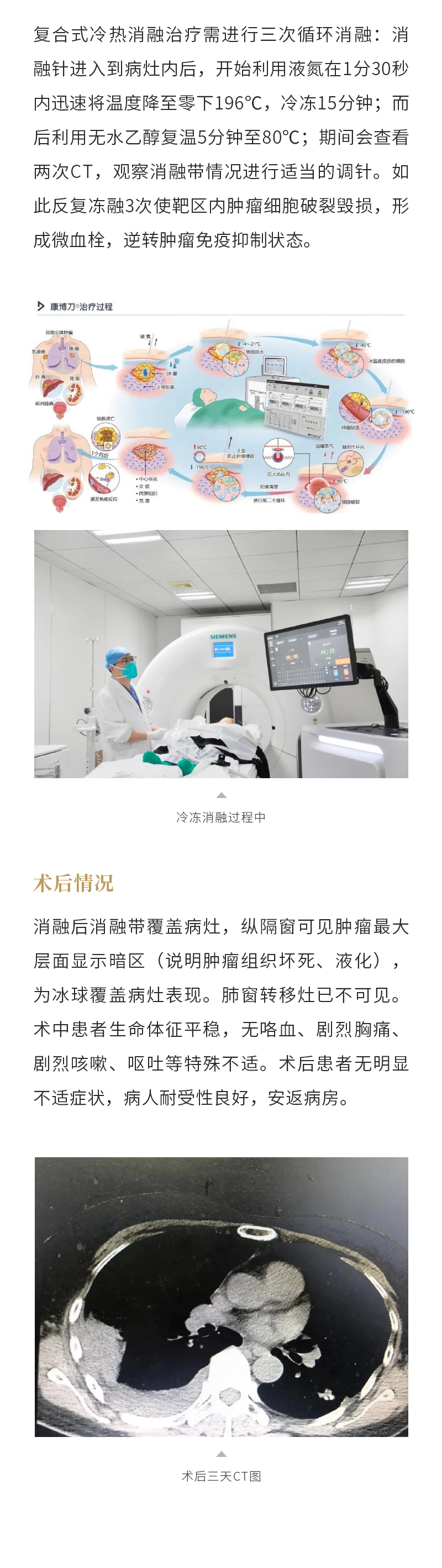 这种癌症最易肺转移?——腺样囊性癌肺转移,复合式冷热消融治疗安全有效!-海杰亚(北京)医疗器械有限公司