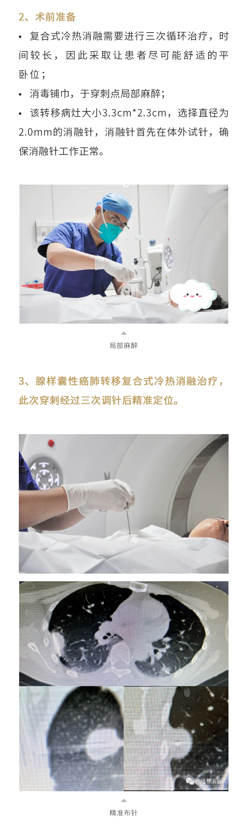 这种癌症最易肺转移?——腺样囊性癌肺转移,复合式冷热消融治疗安全有效!-海杰亚(北京)医疗器械有限公司